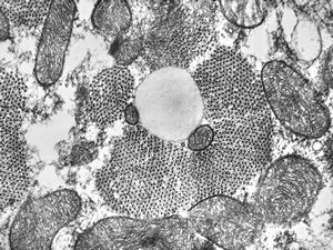 M,15y. | lipid droplet in cardiomyocyte … heart